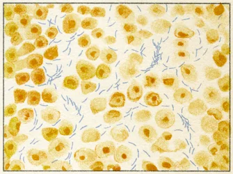 Bactéries de la tuberculose dans les crachats